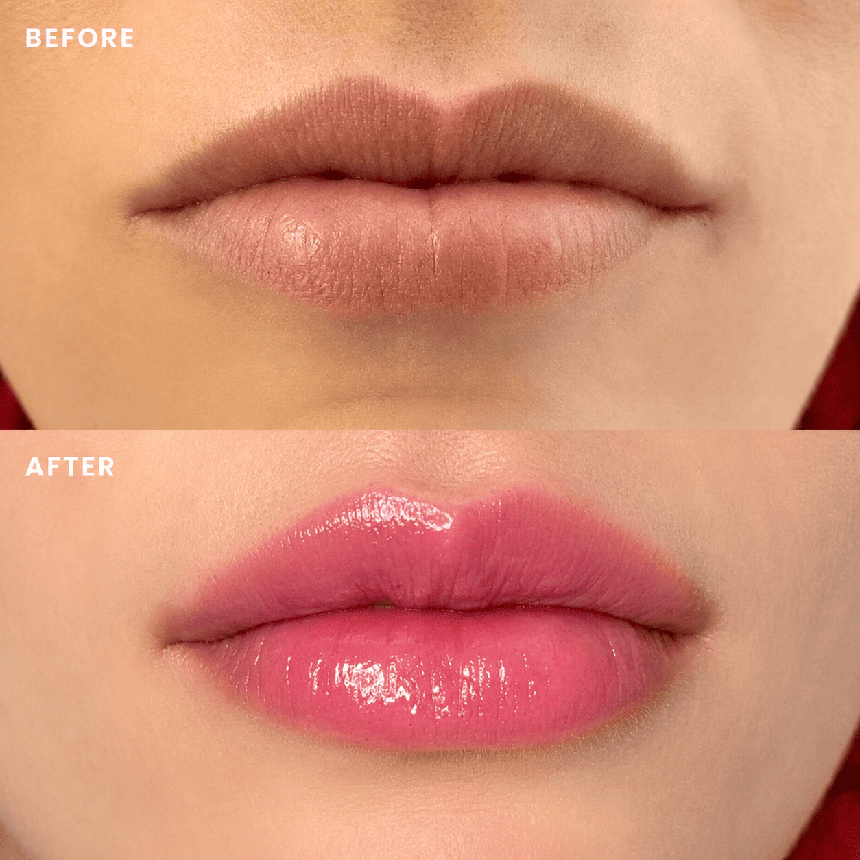 Hyaluron Lip Filler 1
