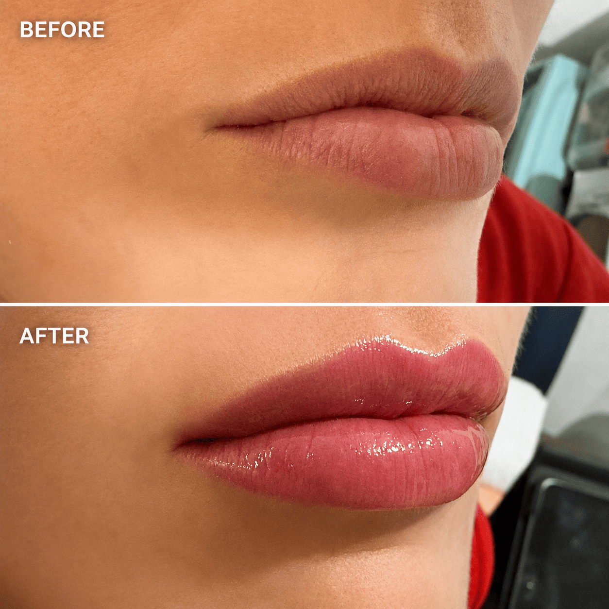 Hyaluron Lip Filler